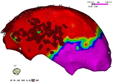 A 3D-printed surgical guide for ischemic scar targeting and ablation